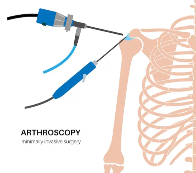 Advanced Arthroscopy in Nagarbhavi for Minimally Invasive Joint Care