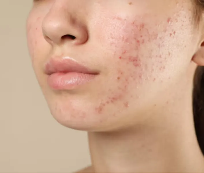 Acne Treatment in Netaji Subhash Place