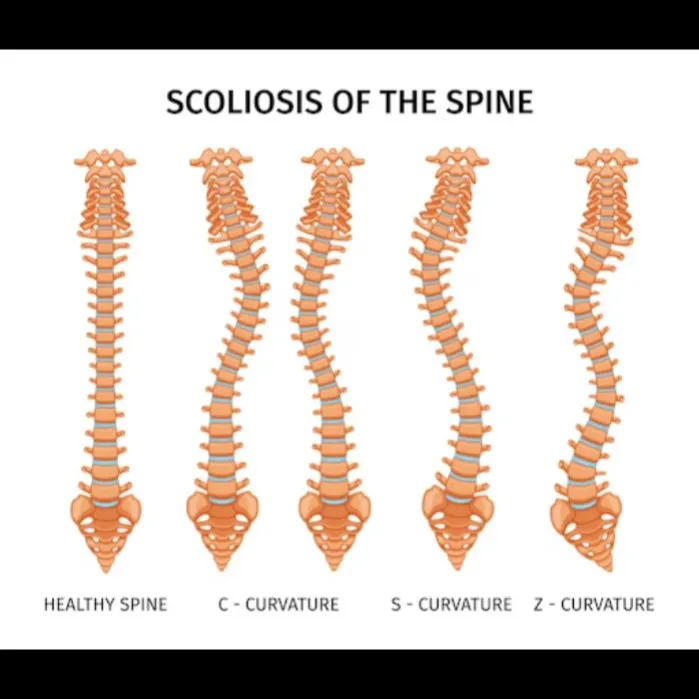 Scoliosis Specialist in Nagpur – Effective Spine T...