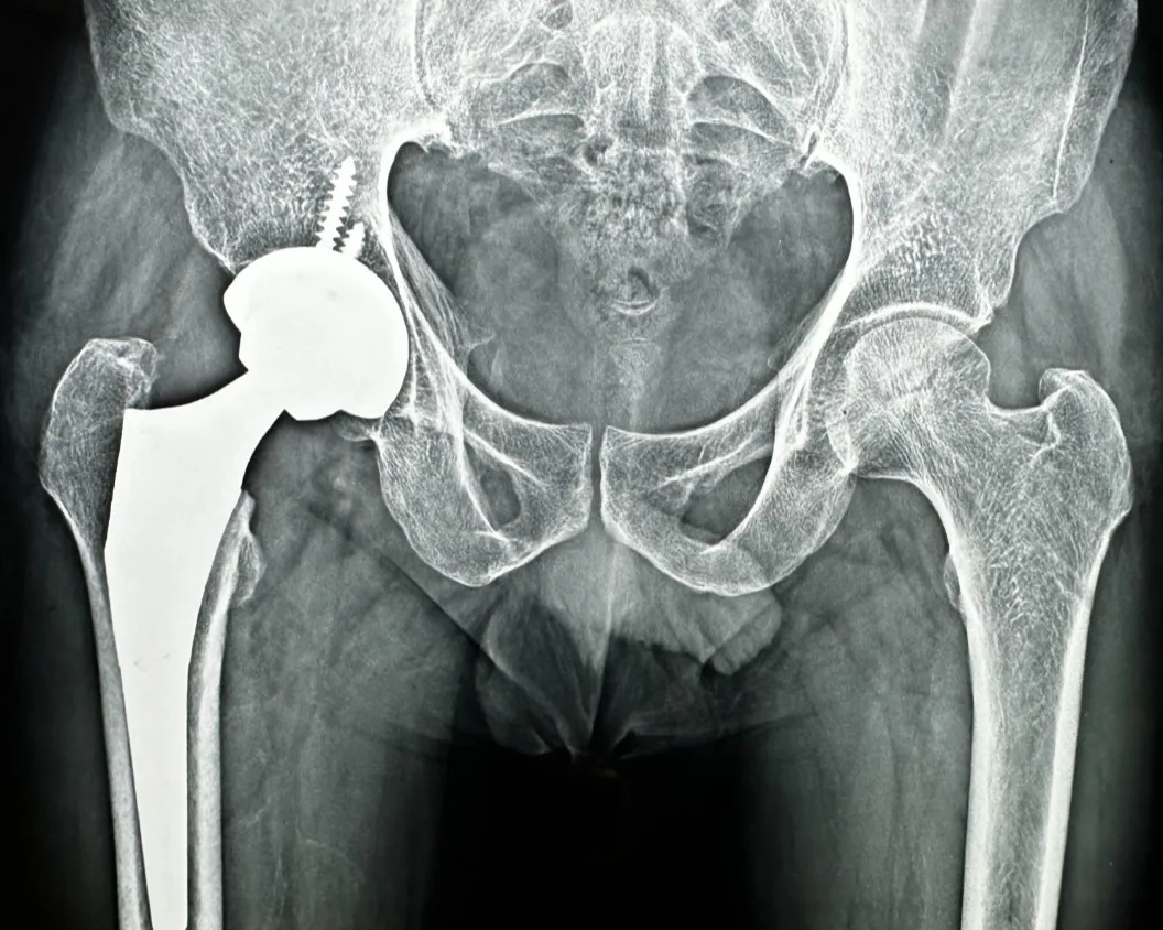 Hip Replacement Surgery in Nagpur – A Step Toward a Pain-Free Life