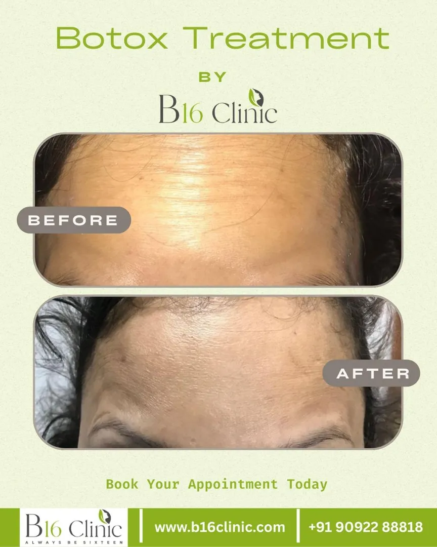 Botox Treatment clinic in Coimbatore