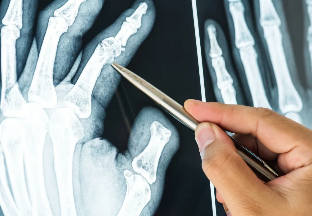 Scaphoid Fracture Surgery in Bangalore – Restoring Wrist Stability