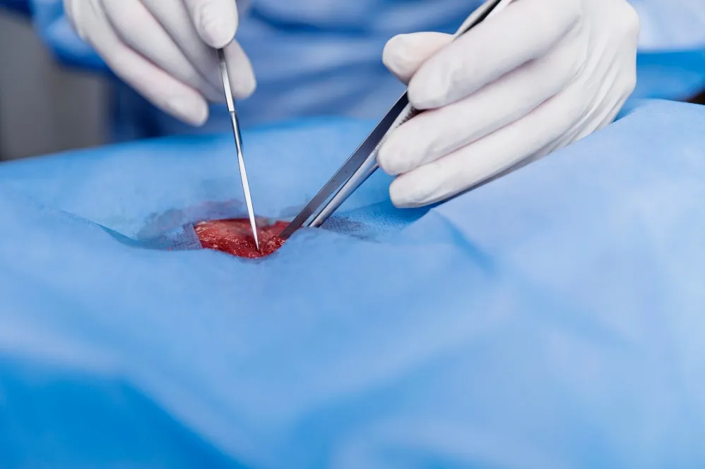 Fistula Treatment in Tathawade
