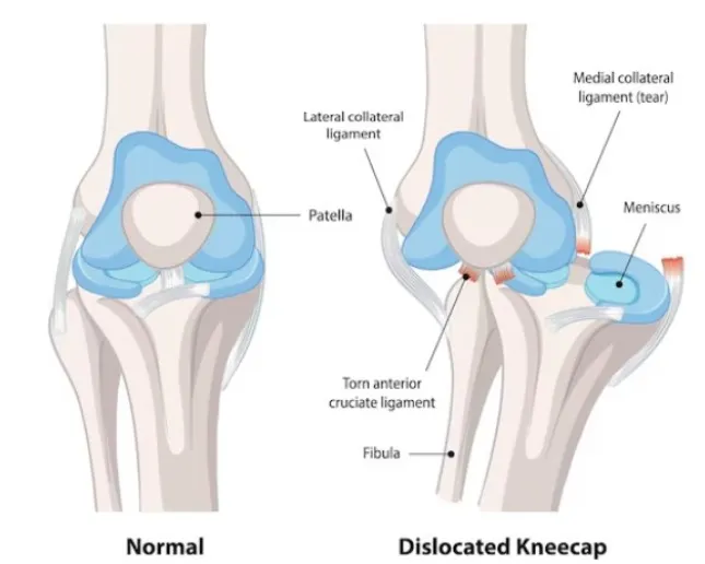 Fracture and Dislocation Specialist in ECR – Timely Healing for Strength