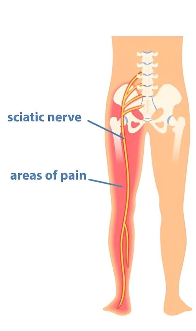 Sciatica Treatment in Noida – Relief from Radiating Pain