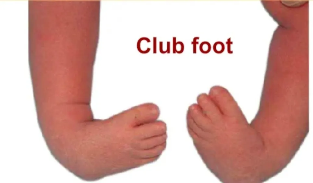 Clubfoot Treatment Doctor in Nagpur – Corrective Solutions for Foot Deformities