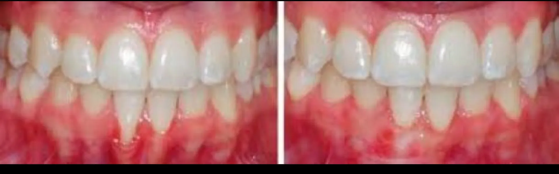Mucogingival Treatment in Dhule – Advanced Gum Care at Gindodia Hospital