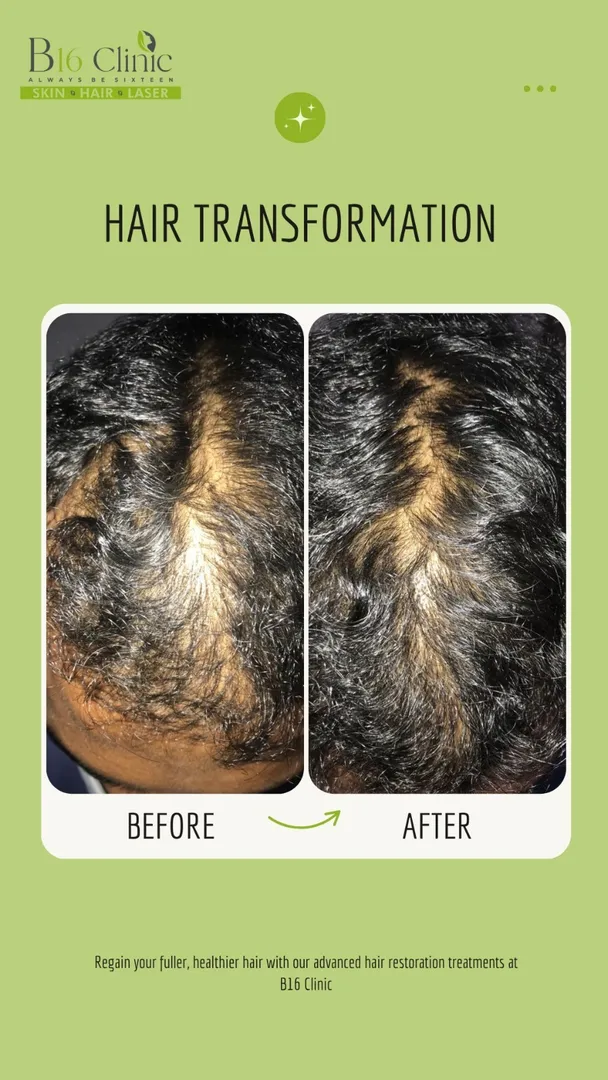 Hair transformation clinic in saravanampatti