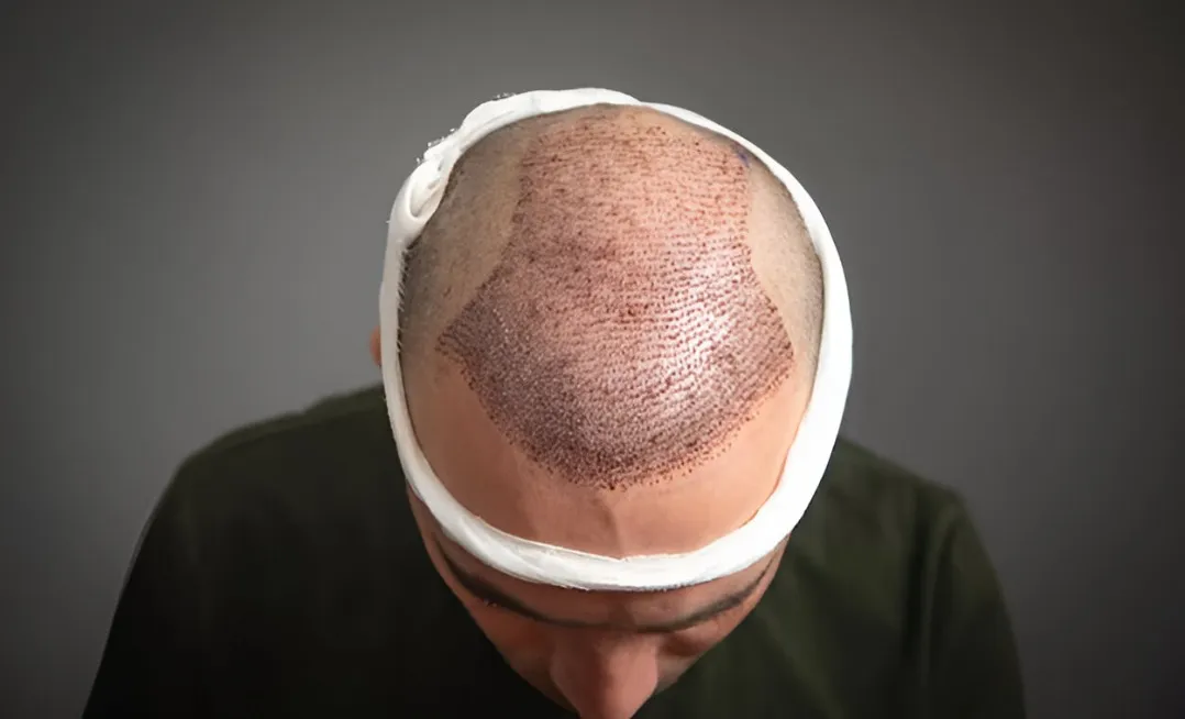 Best Hair Transplant Doctor in Nagpur – Restore Confidence with Natural Results