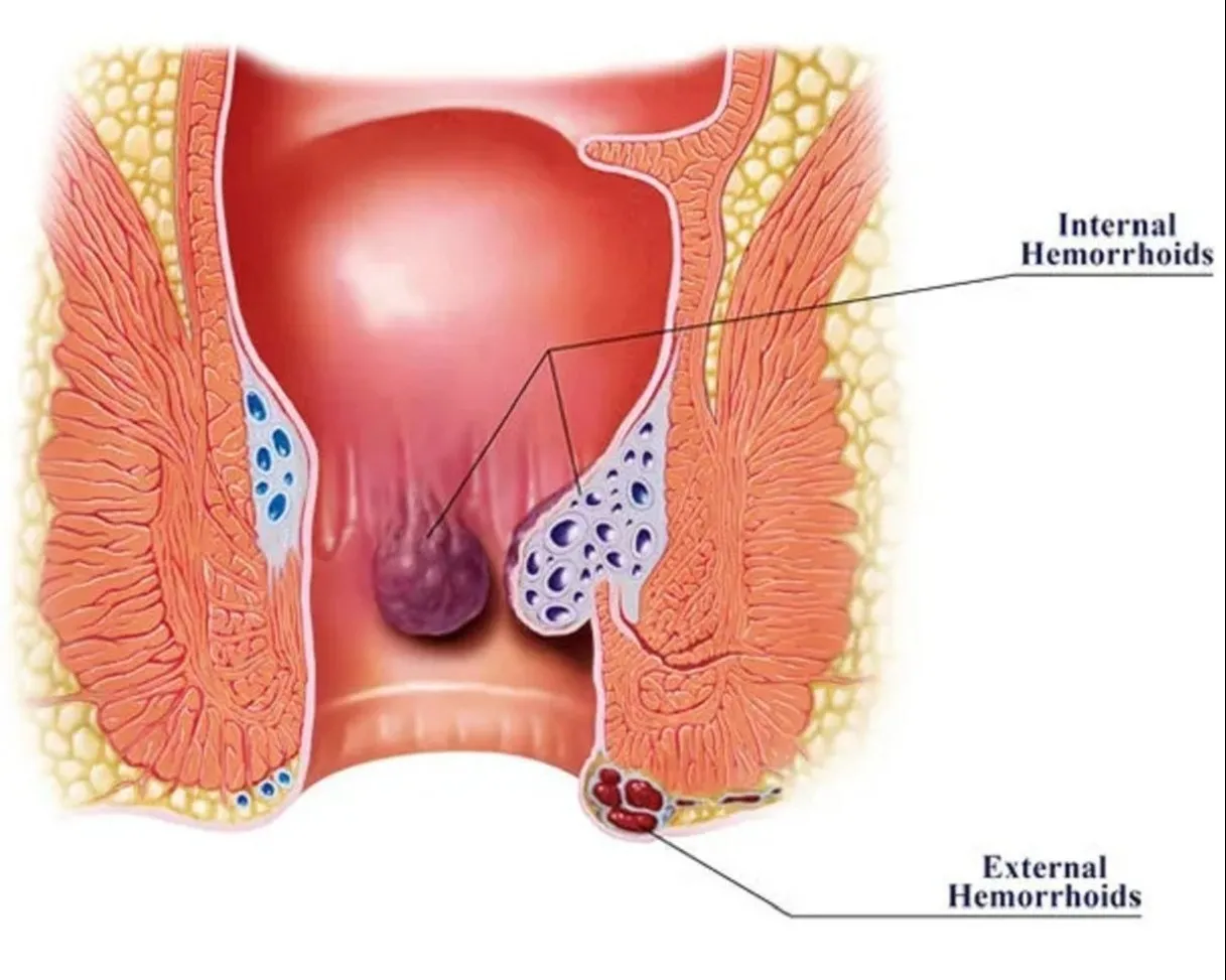Piles Treatment Doctor in Chembur - Relief with Expert Care