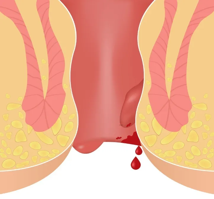 Piles Surgeon in Kolathur, Chennai