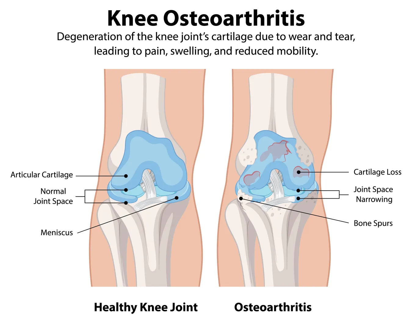 Osteoarthritis Specialist in Pune – Move Freely Without Joint Pain