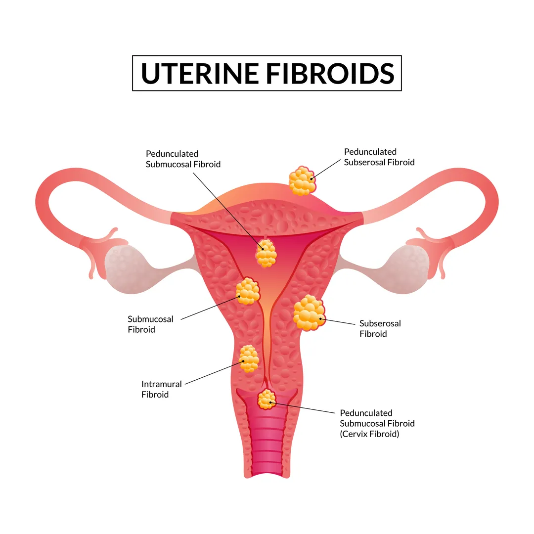 Uterine Fibroid Treatment Doctors in Thane – Relief with Modern Care