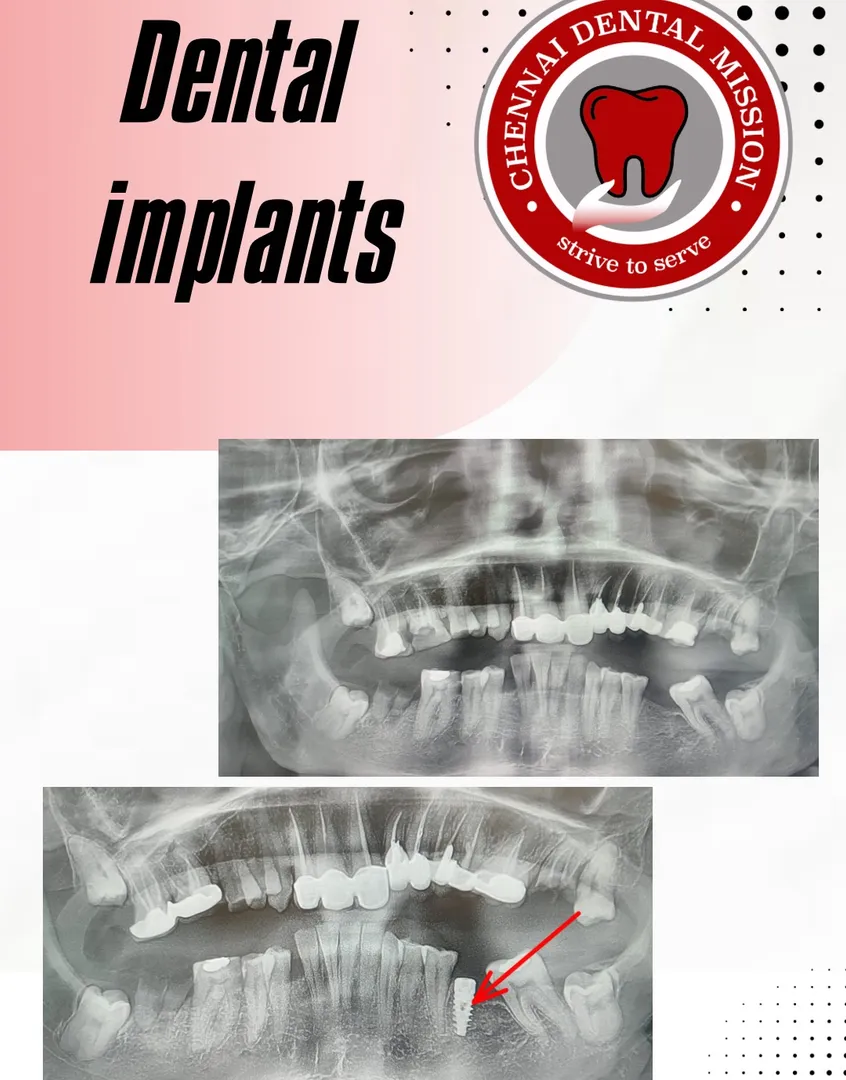 Dental Implants in Anna Nagar, Chennai – Restore Your Missing Teeth at Chennai Dental Mission