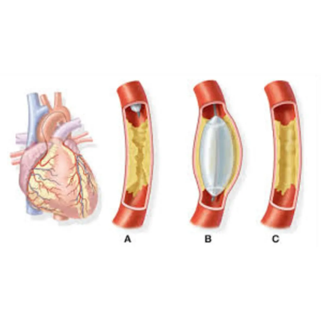 Angiography in Pune