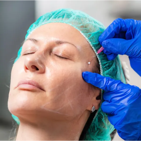 Thread Lift Treatment in Chennai