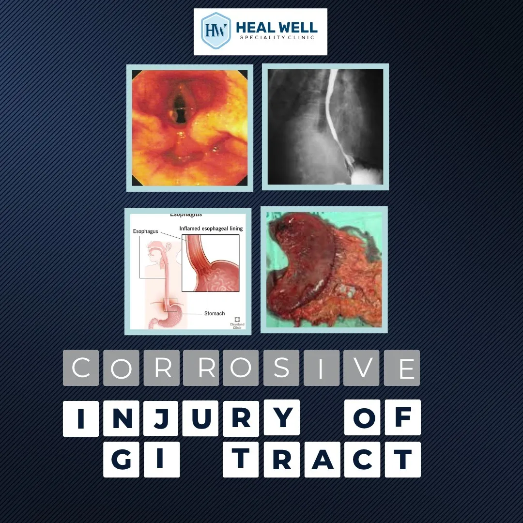 Corrosive injury to GI tract