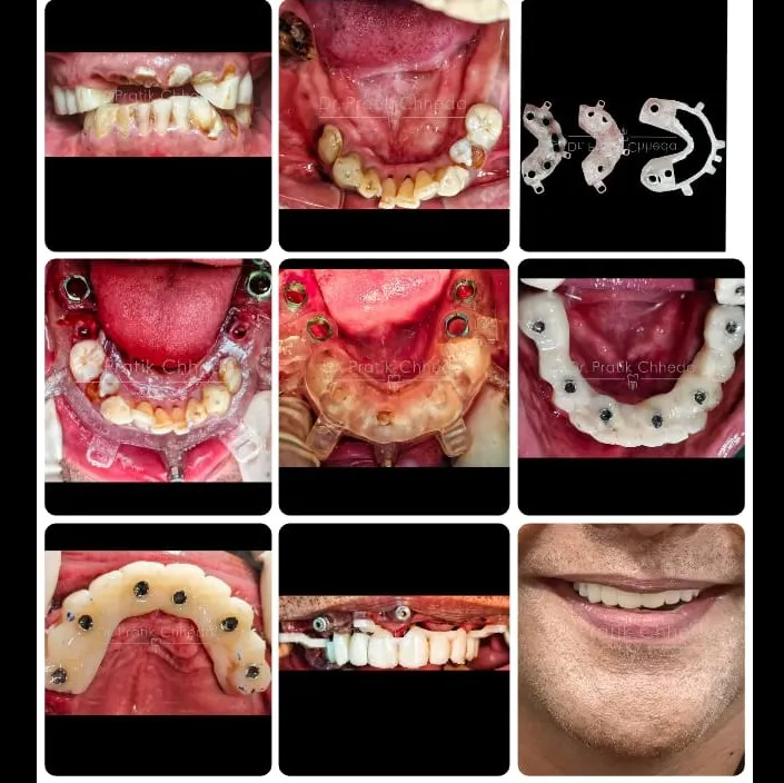 STACKABLE SURGICAL GUIDE FOR IMPLANT SURGERY