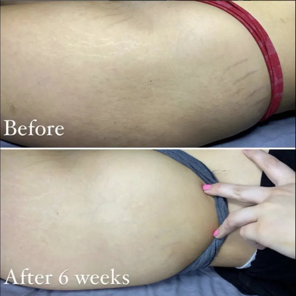 Best Stretch Mark Removal in Dhule – Gindodia Hospital