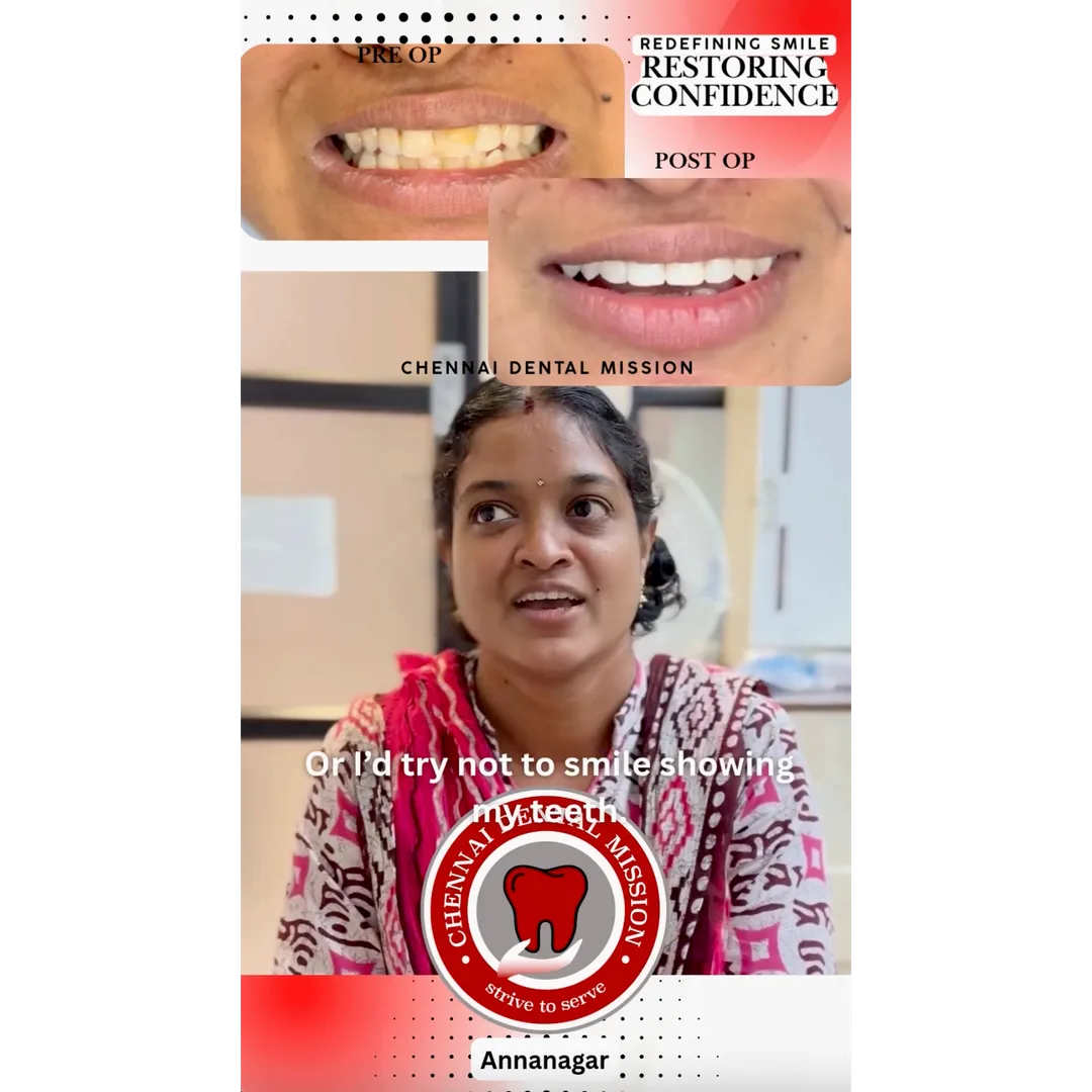 At Chennai Dental Mission, Anna Nagar, we believe a confident smile can change your life. Many patie...