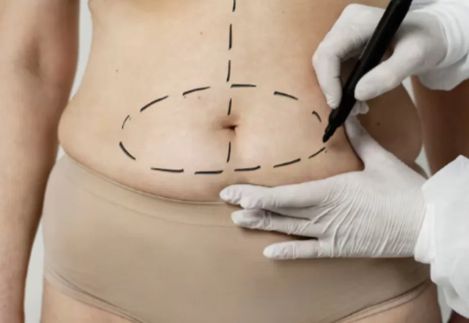 Tummy Tuck in Bangalore – Restore Strength and Contour