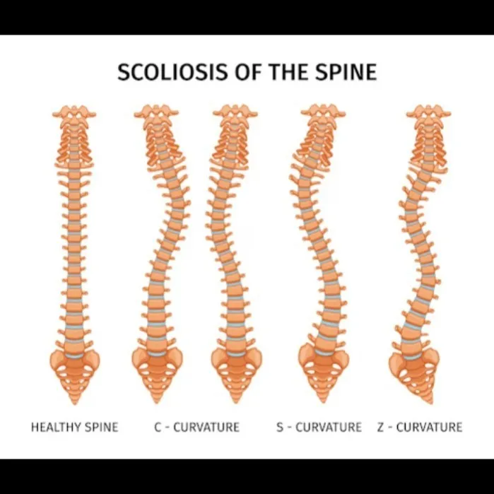 Scoliosis Specialist in Nagpur – SUYOG HOSPITAL NAGPUR