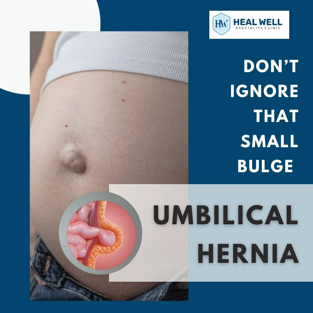 Umbilical Hernia in Thane