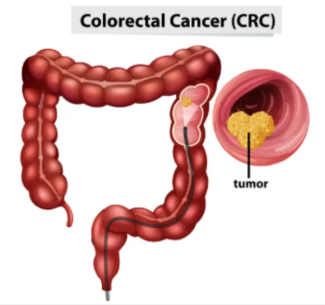 Colon Cancer Screening in Mumbai