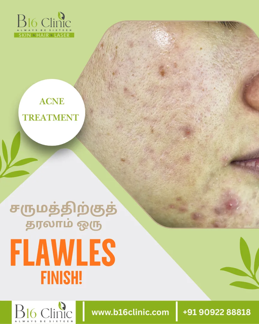 Acne Treatment in Coimbatore