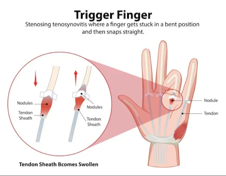 Regain Finger Flexibility with Trigger Finger Treatment in Chembur