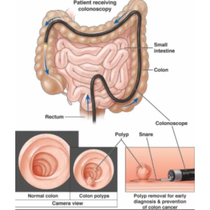 Colonic Polyps Diagnosis and Treatment in Mumbai