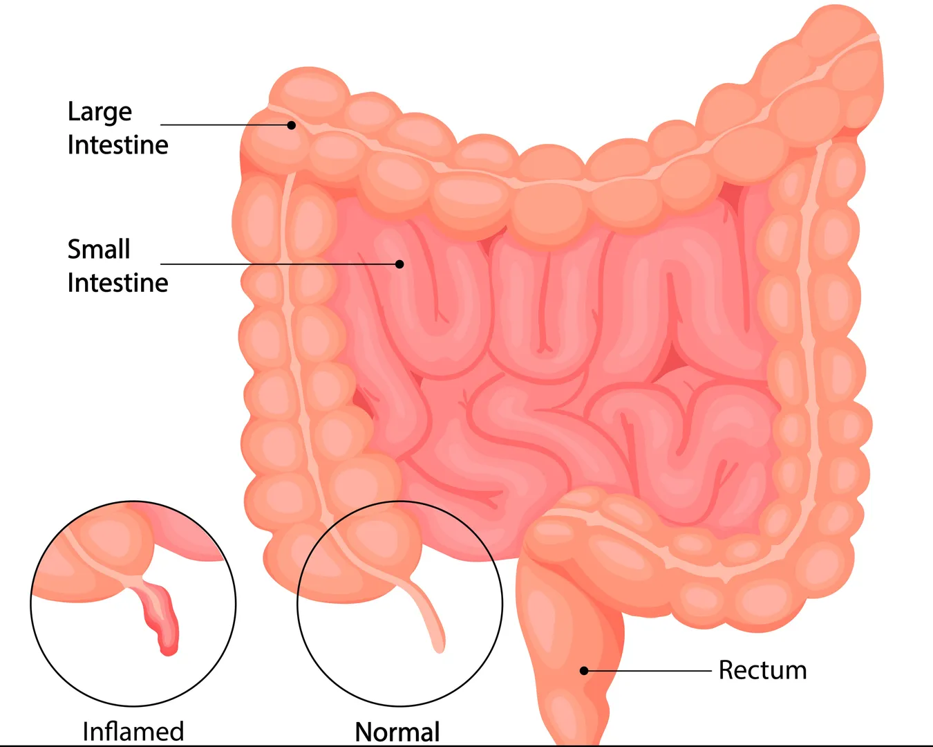 Appendix Surgery in Kolathur, Chennai