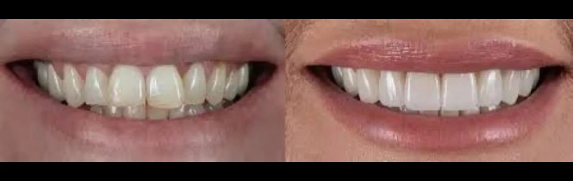 Dental Laminates Treatment in Dhule – Gindodia Hospital