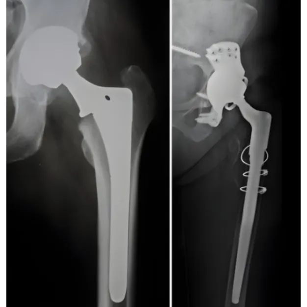 Primary Hip Replacement in Bangalore – Rediscover Pain-Free Living