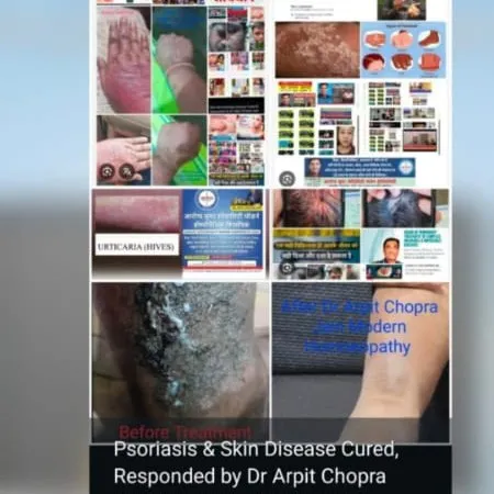 Psoriasis सोरायसिस में राहत मिली Indore के मरीज को –Aarogya Super Speciality Modern Homeopathy Indor...