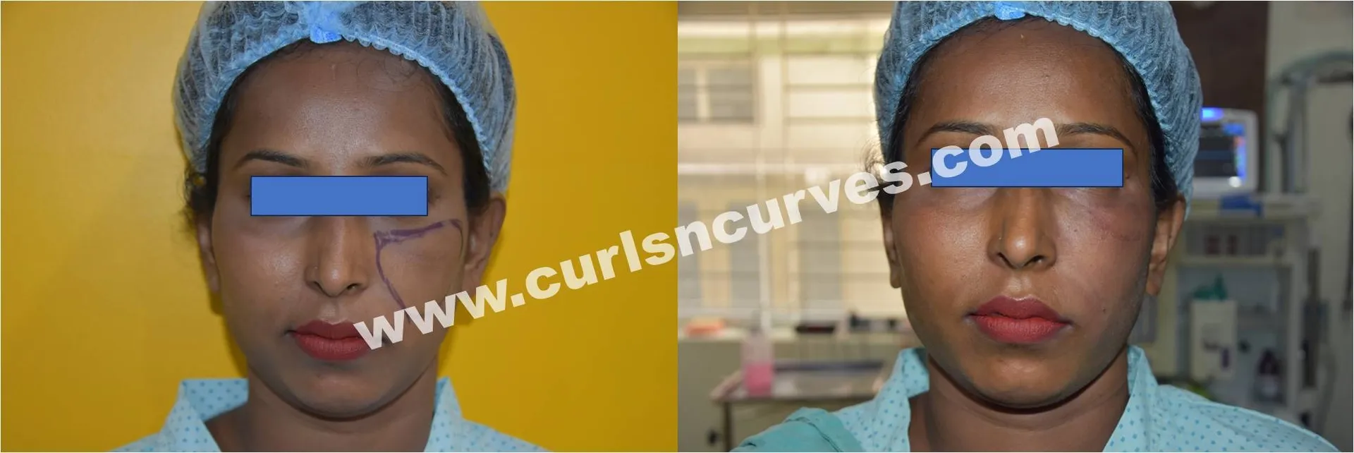 Fat Grafting in Bangalore – Natural Volume, Long-Lasting Results