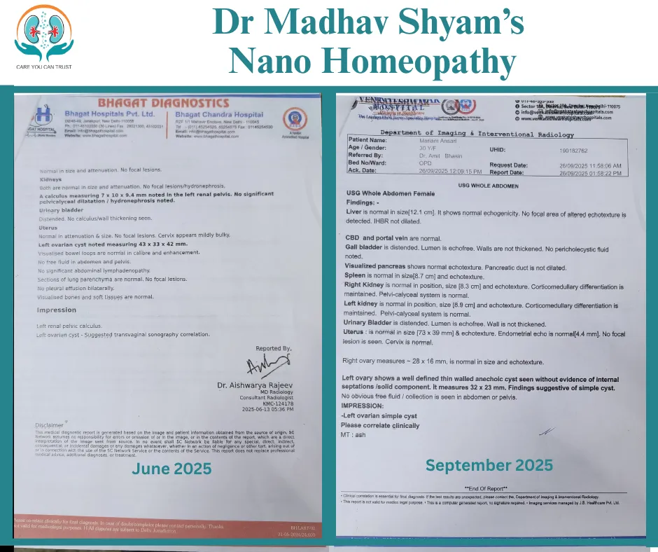 Mariam Ansari, came to Nano homeopathy in the month of June, 2025 for the treatment of a kidney ston...