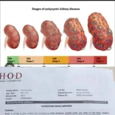Polycystic Kidney Disease & CKD Kidney Failure responded by Dr Arpit Chopra Jain Aarogya Super Spec...
