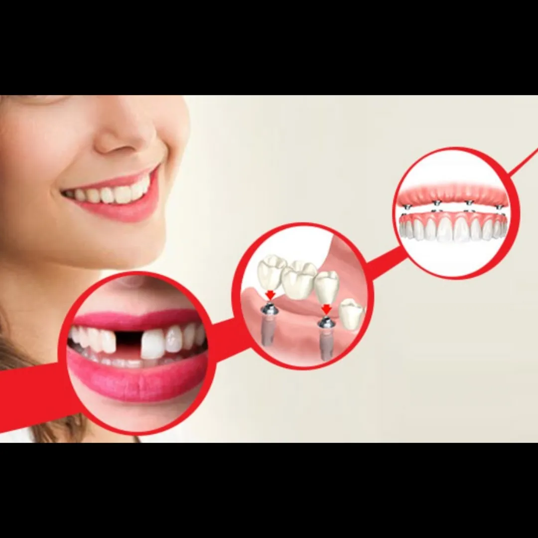 Replacement of Missing Teeth in Lajpat Nagar, New Delhi