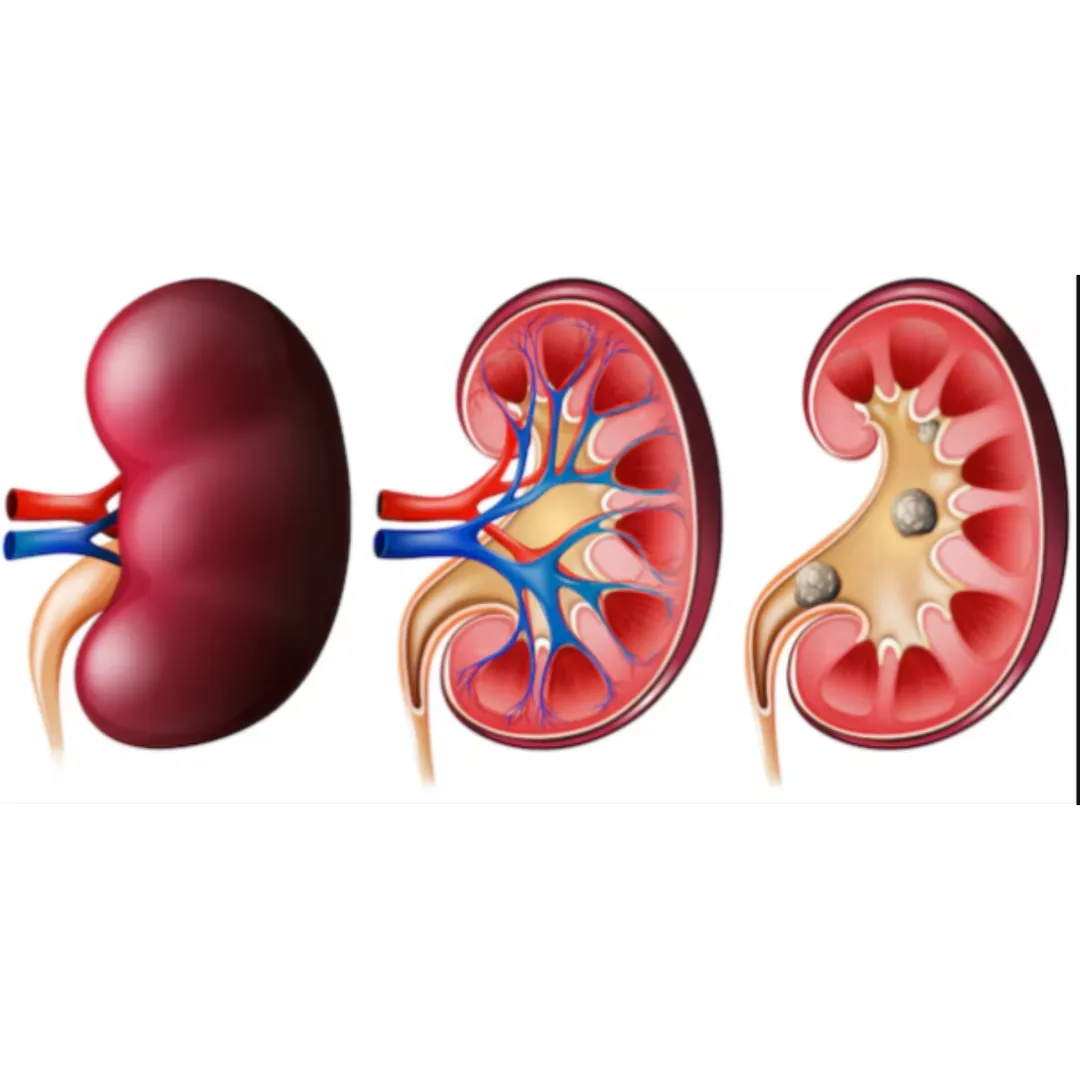 Kidney Stone Prevention Tips in Thane – Stay Stone-Free Naturally