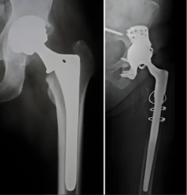 Revision Hip Replacement in Bangalore – Restoring Function and Comfort