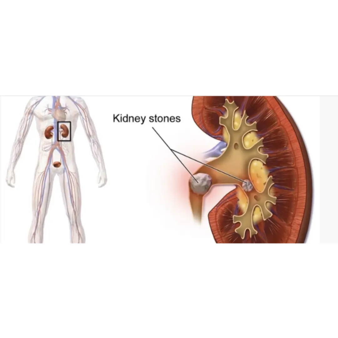 Kidney Stone Treatment in Ahmedabad