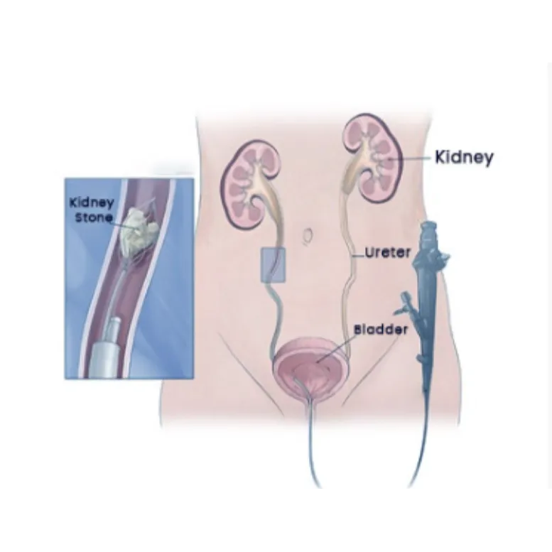 Kidney Stone Treatment in Ahmedabad