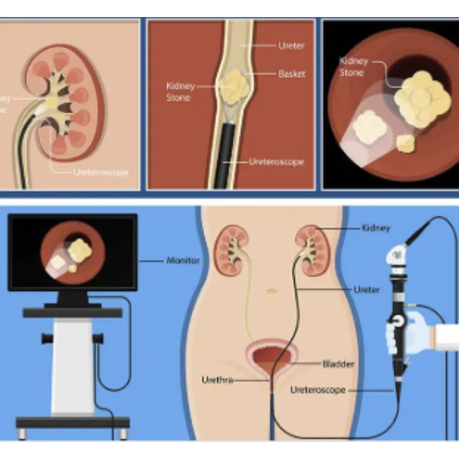 Ureteroscopy Treatment in Ahmedabad