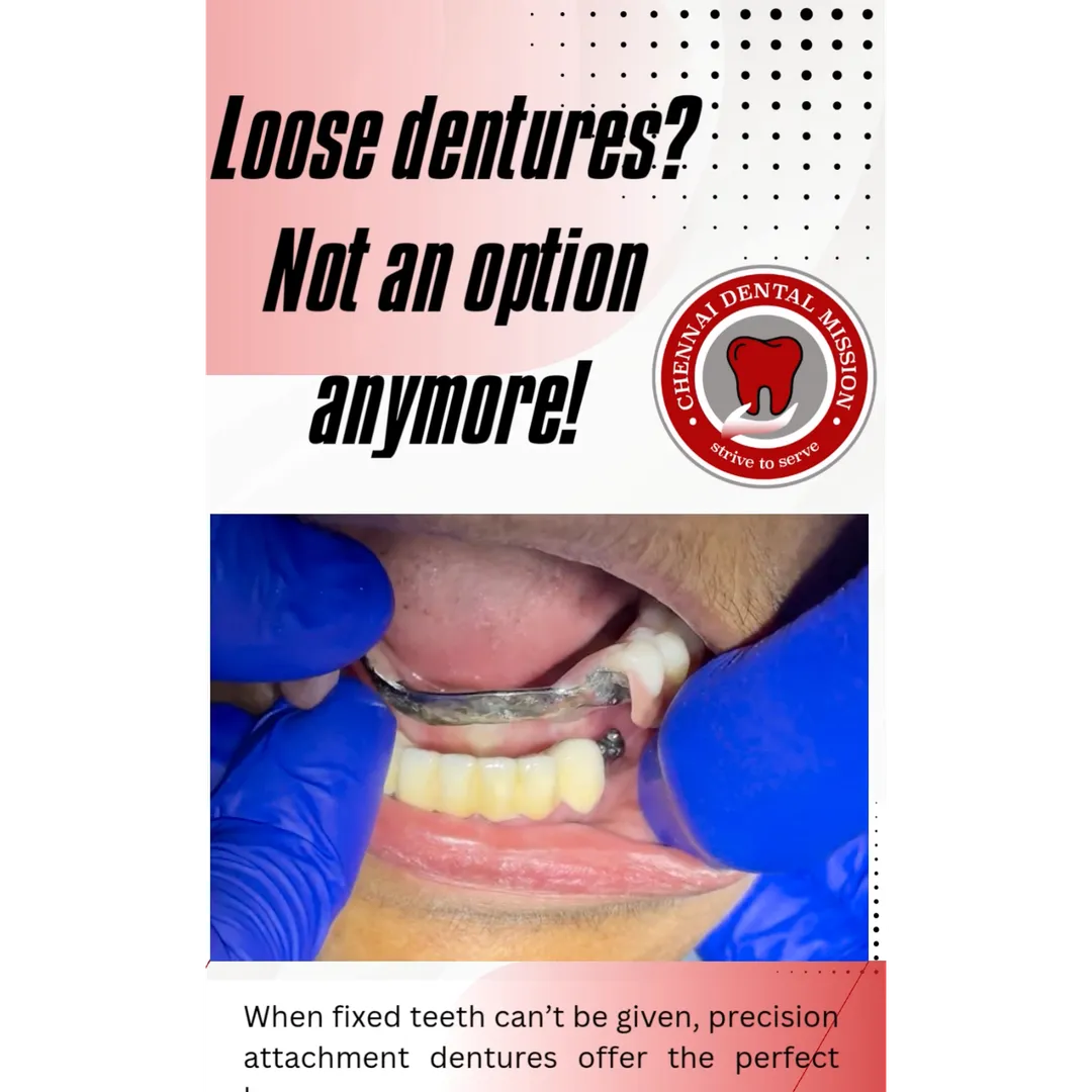 Precision Attachment Dentistry in Anna Nagar | The Perfect Blend of Comfort, Function, and Aesthetic