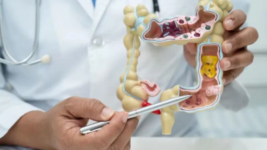 Appendicectomy in CBD – Minimally Invasive and Safe