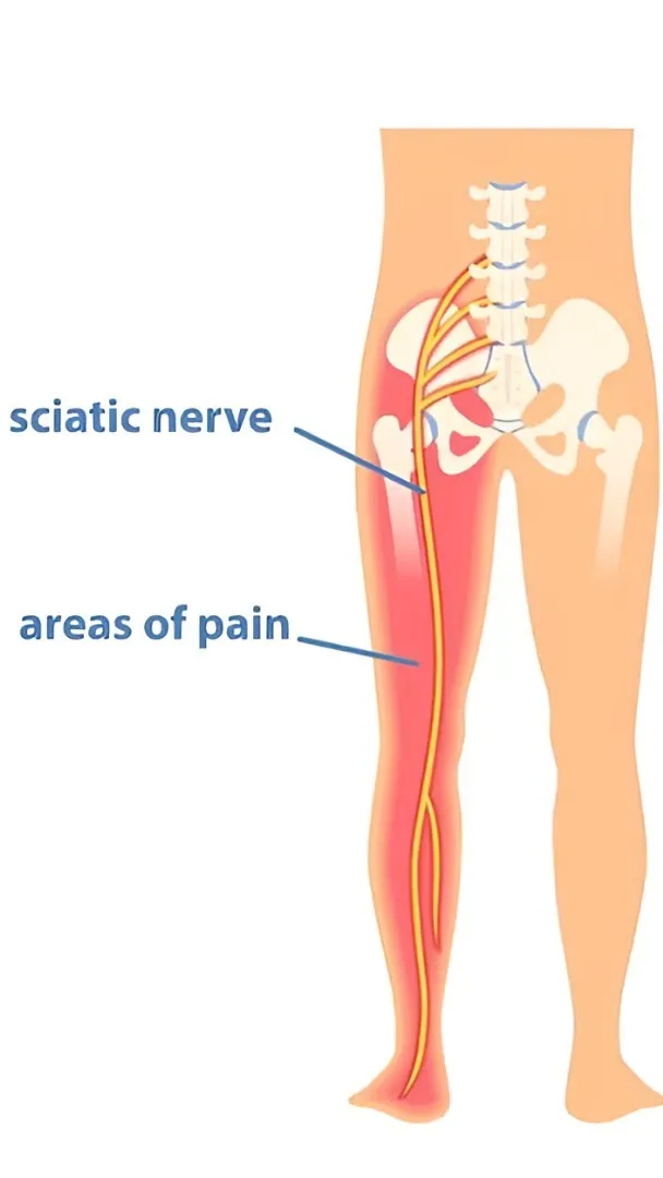 Cervical and Sciatica Treatment in Noida