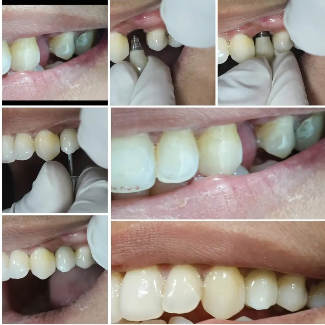 MISSING TOOTH REPLACEMENT WITH IMPLANT AND ZIRCONIA CROWN