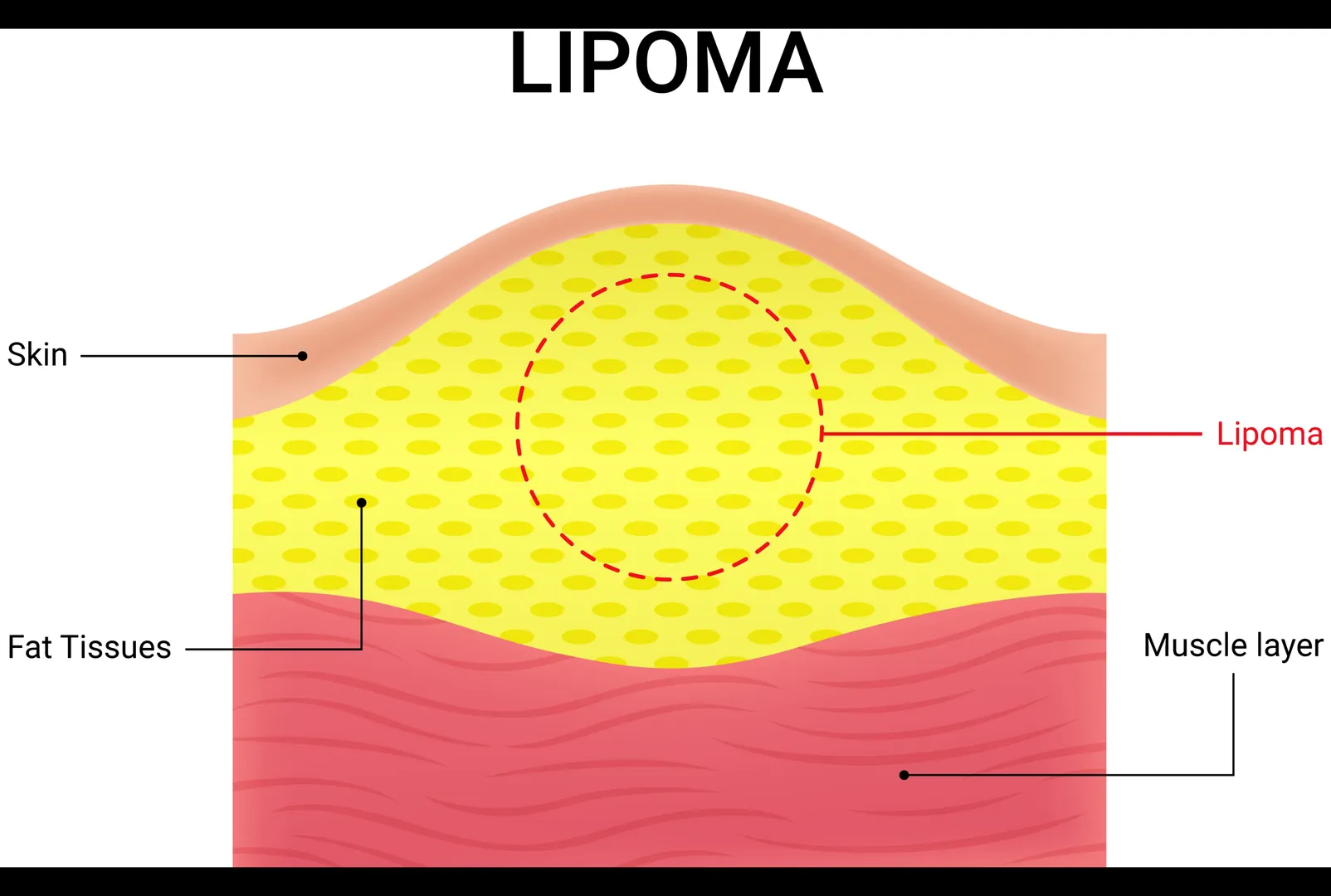 Lipoma Removal in Kolathur, Chennai