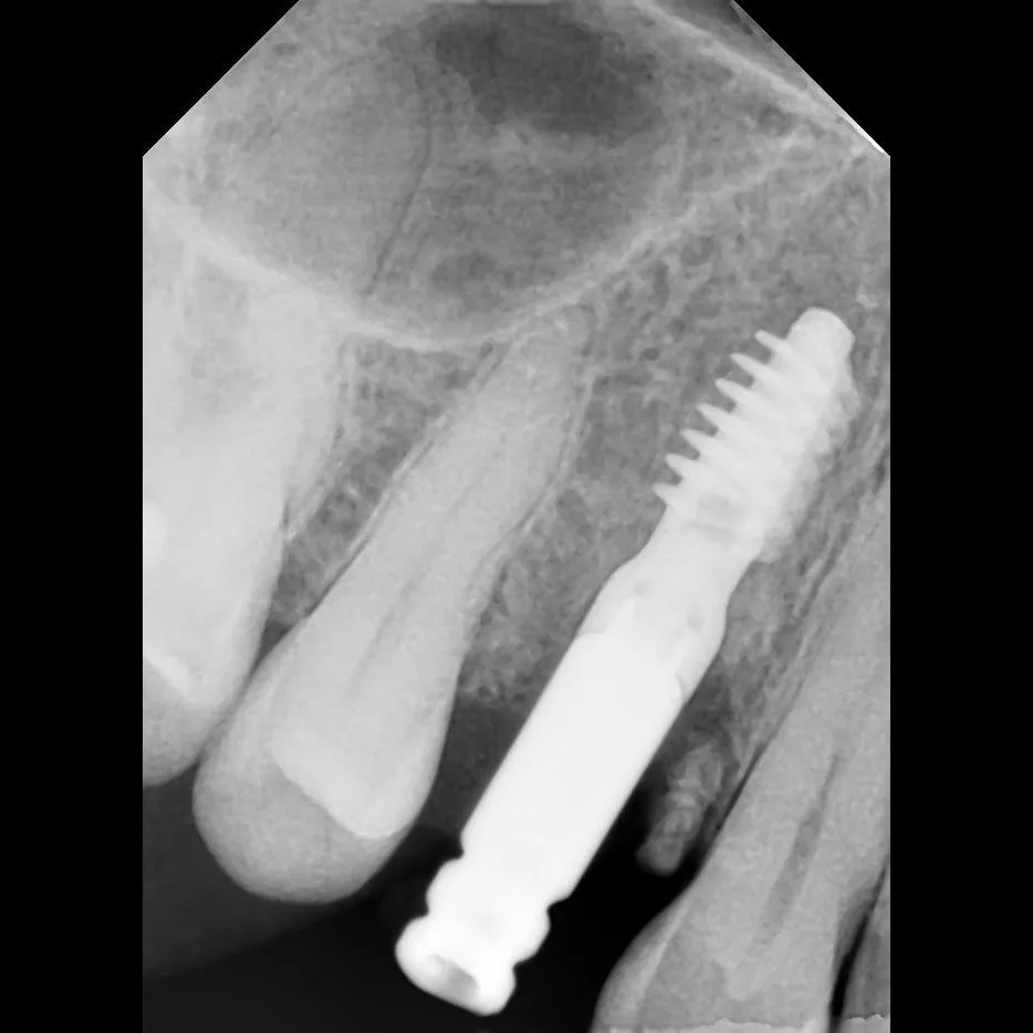 Best Treatment for Immediate Loading Implants in Lajpat Nagar.